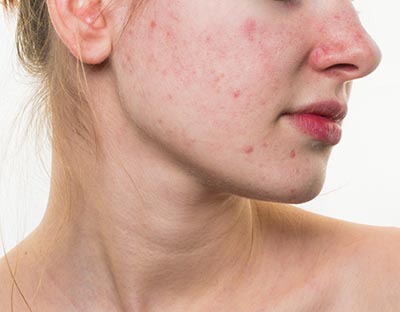 shutterstock_255146332 bumser pubertet 400px